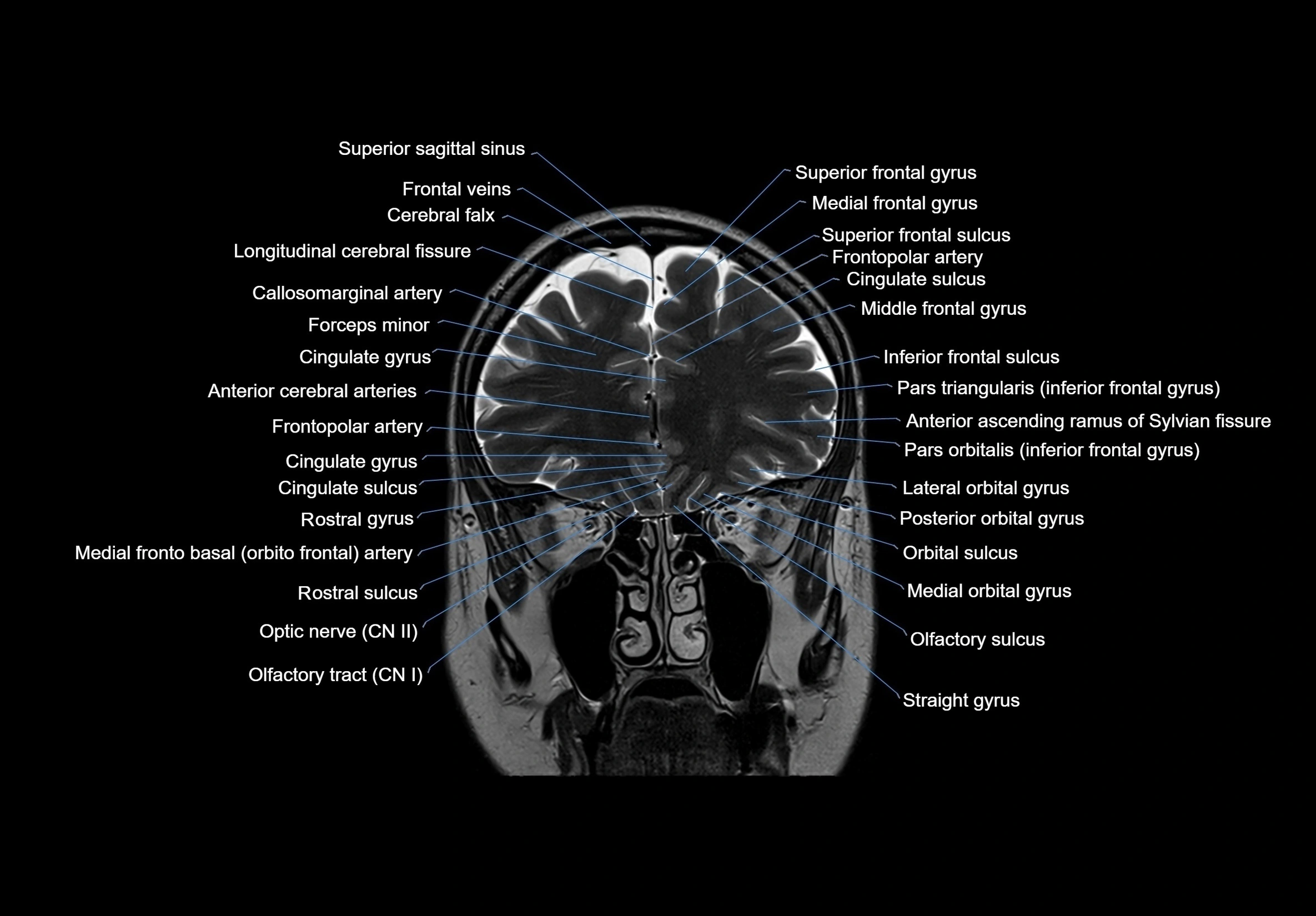 MRI Brain coronal cross sectional labelled anatomy 3T image  -img-00001-00020.webp